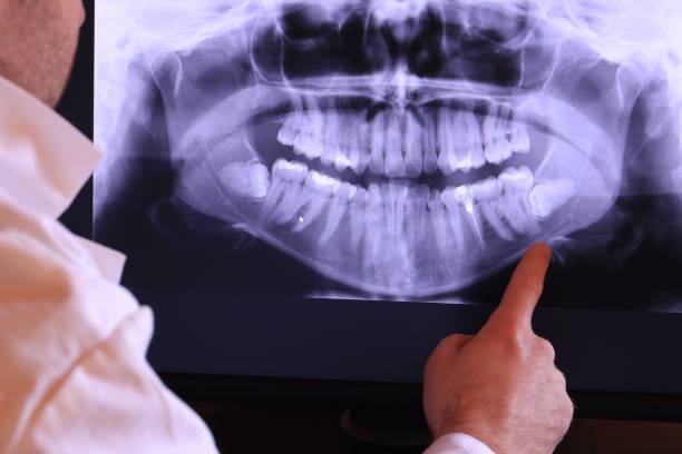 Best Emergency Wisdom Teeth Removal in Campton Hls, IL