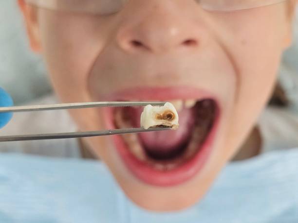 Best Emergency Tooth Extraction in Campton Hls, IL